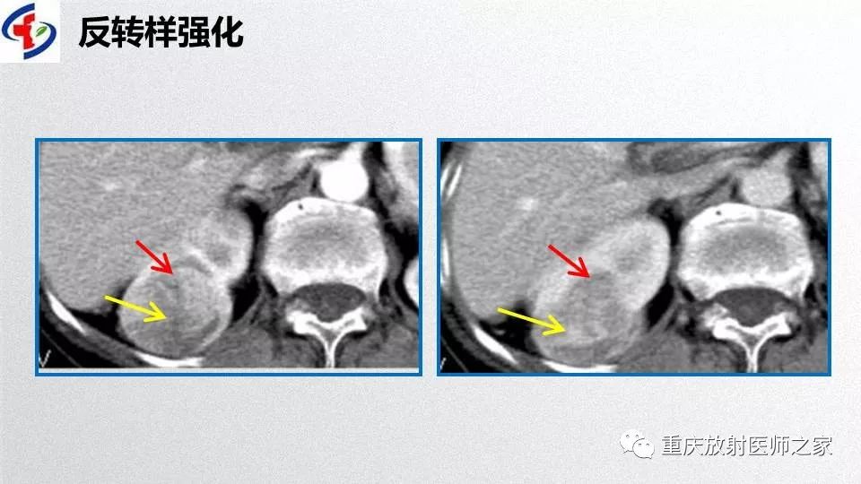 影像PPT - 【PPT】肾癌常见亚型的影像学表现及鉴别诊断-56