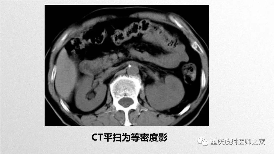 影像PPT - 【PPT】肾癌常见亚型的影像学表现及鉴别诊断-65