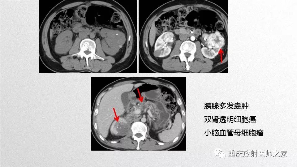 影像PPT - 【PPT】肾癌常见亚型的影像学表现及鉴别诊断-70