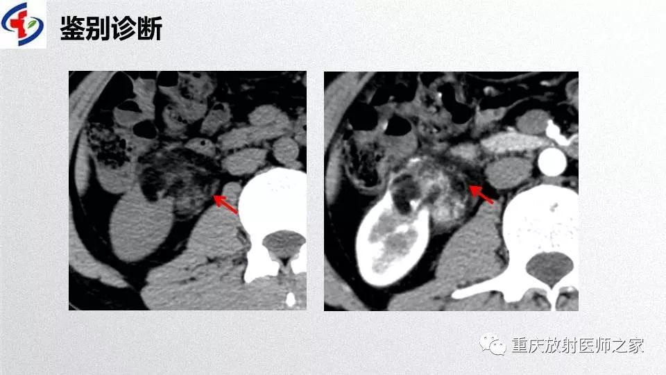 影像PPT - 【PPT】肾癌常见亚型的影像学表现及鉴别诊断-73