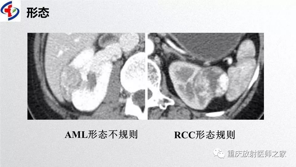 影像PPT - 【PPT】肾癌常见亚型的影像学表现及鉴别诊断-76