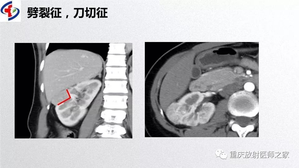 影像PPT - 【PPT】肾癌常见亚型的影像学表现及鉴别诊断-77