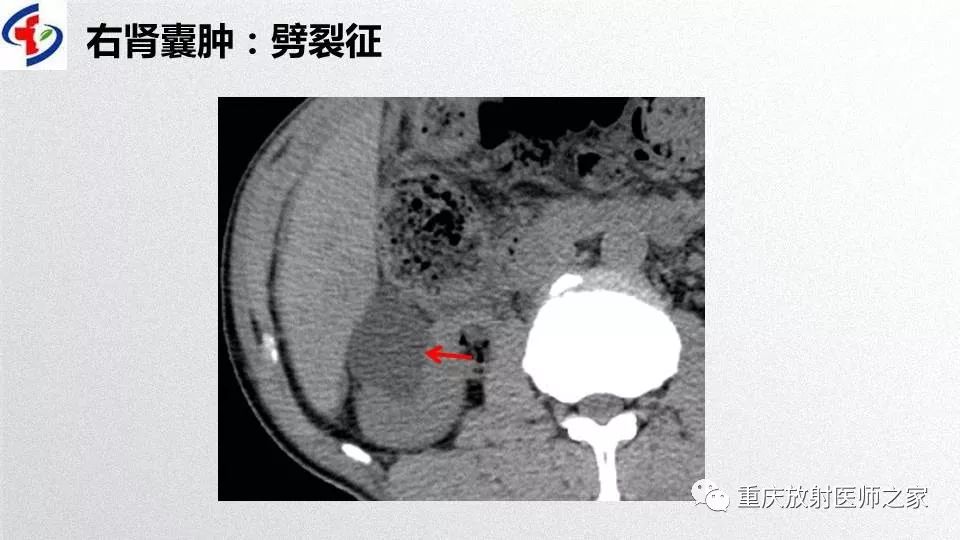 影像PPT - 【PPT】肾癌常见亚型的影像学表现及鉴别诊断-78