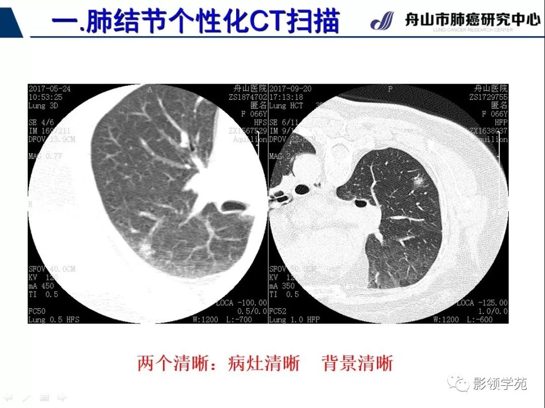 影像PPT - 【PPT】肺磨玻璃结节CT精确检查技术的临床应用-9