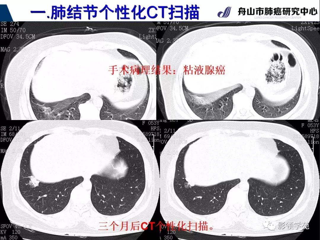 影像PPT - 【PPT】肺磨玻璃结节CT精确检查技术的临床应用-10
