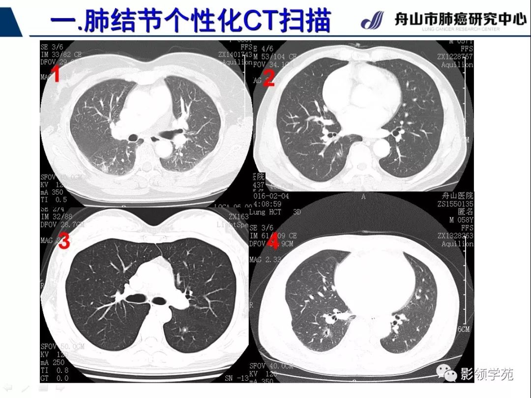 影像PPT - 【PPT】肺磨玻璃结节CT精确检查技术的临床应用-11