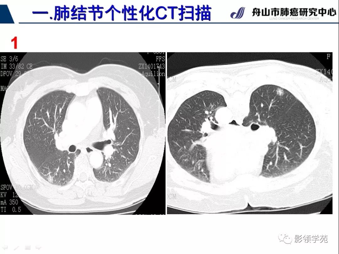 影像PPT - 【PPT】肺磨玻璃结节CT精确检查技术的临床应用-12