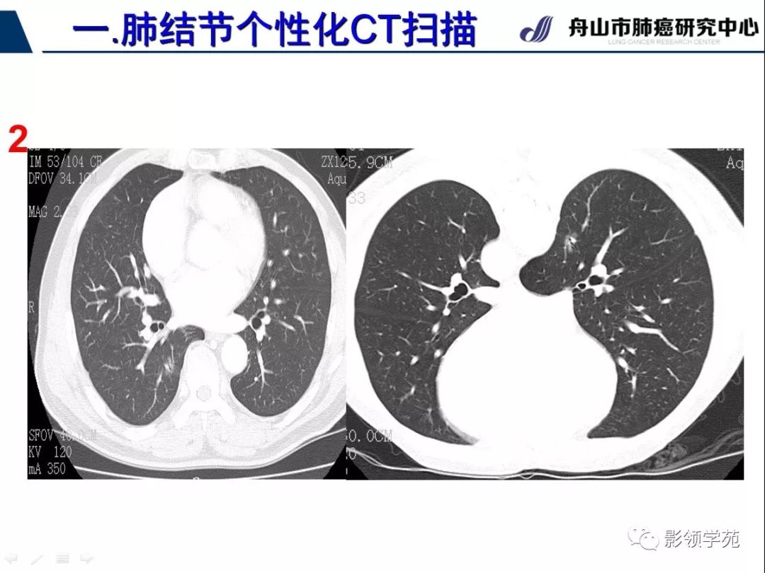 影像PPT - 【PPT】肺磨玻璃结节CT精确检查技术的临床应用-14