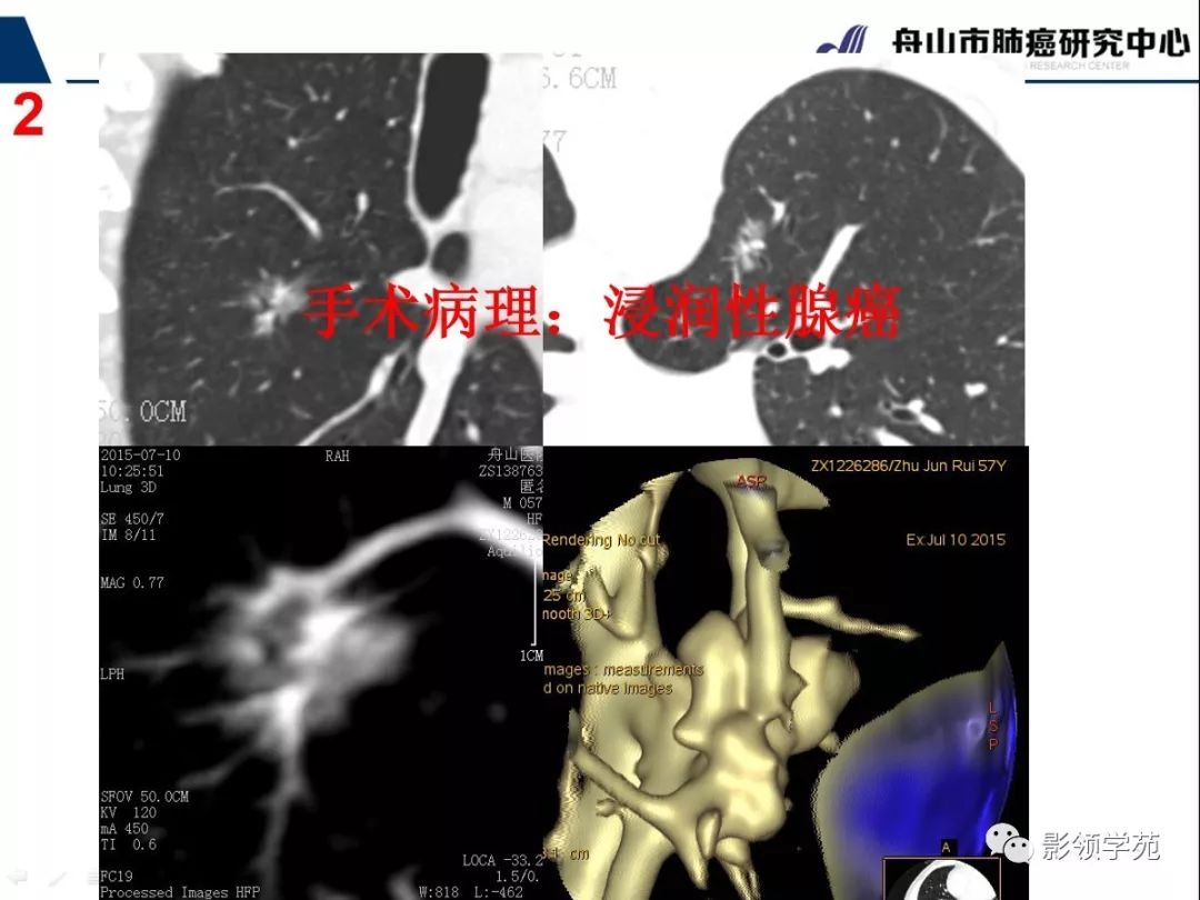 影像PPT - 【PPT】肺磨玻璃结节CT精确检查技术的临床应用-15