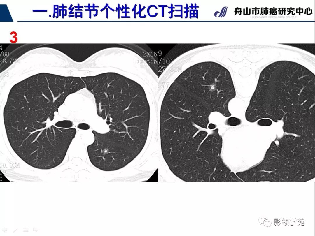 影像PPT - 【PPT】肺磨玻璃结节CT精确检查技术的临床应用-16