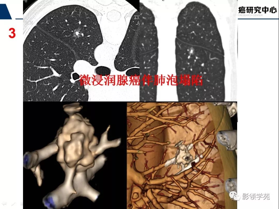 影像PPT - 【PPT】肺磨玻璃结节CT精确检查技术的临床应用-17