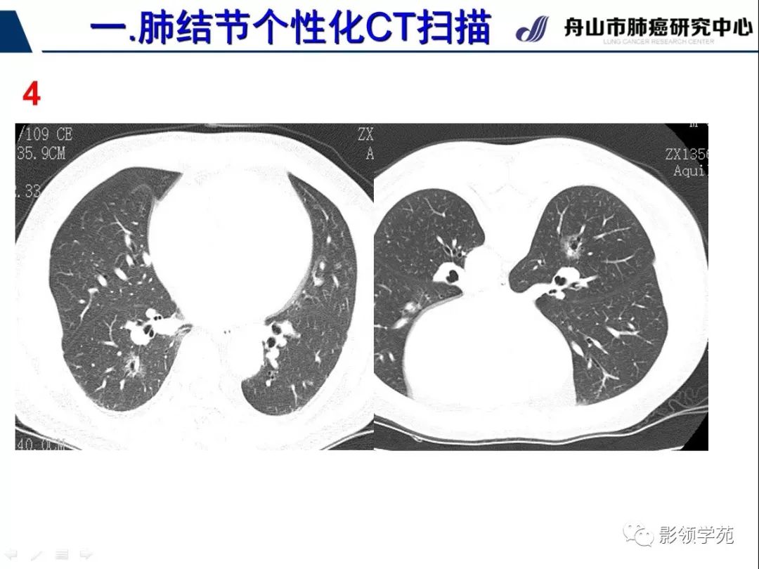 影像PPT - 【PPT】肺磨玻璃结节CT精确检查技术的临床应用-18