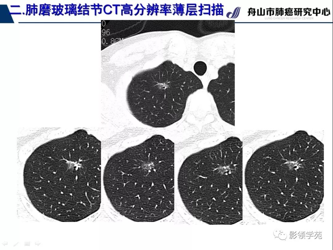 影像PPT - 【PPT】肺磨玻璃结节CT精确检查技术的临床应用-23