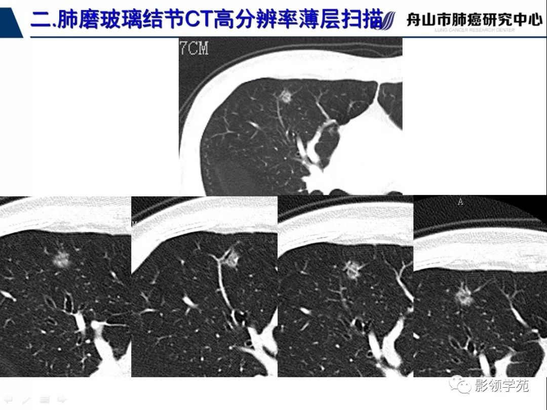 影像PPT - 【PPT】肺磨玻璃结节CT精确检查技术的临床应用-24