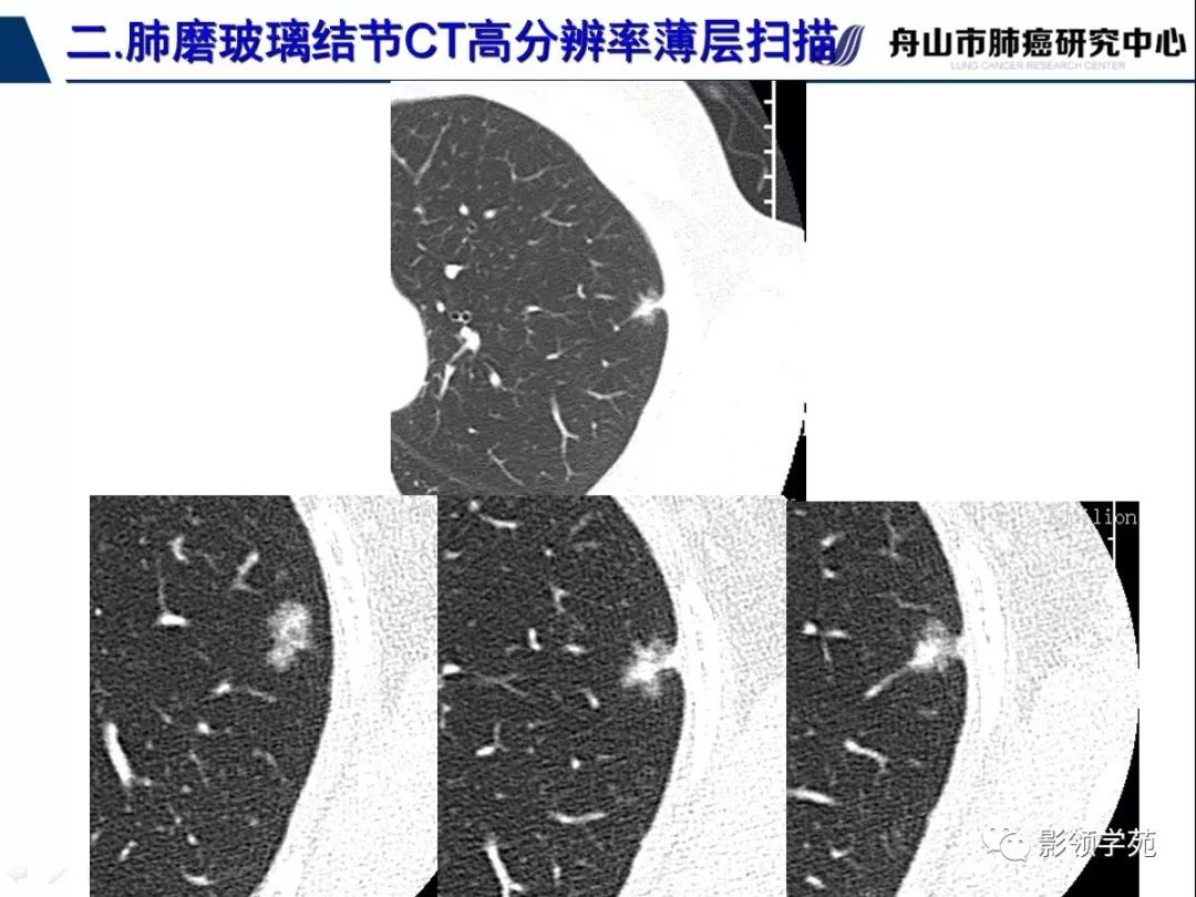 影像PPT - 【PPT】肺磨玻璃结节CT精确检查技术的临床应用-25