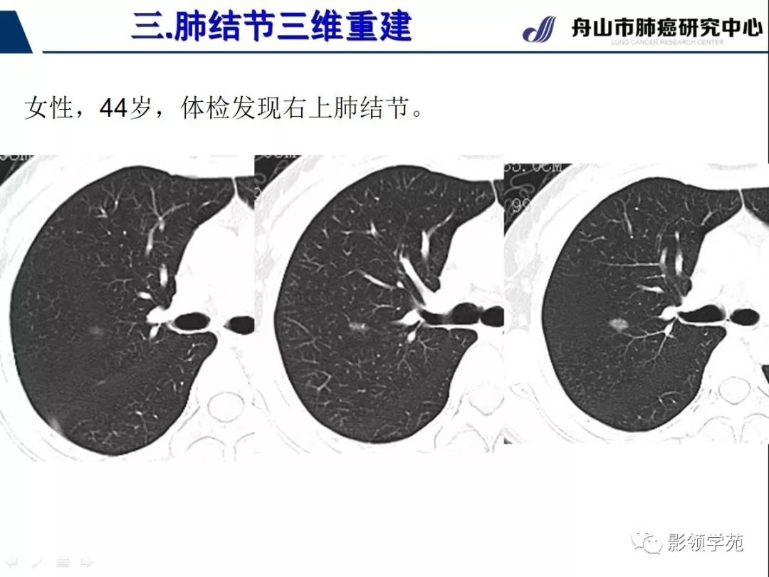 影像PPT - 【PPT】肺磨玻璃结节CT精确检查技术的临床应用-30