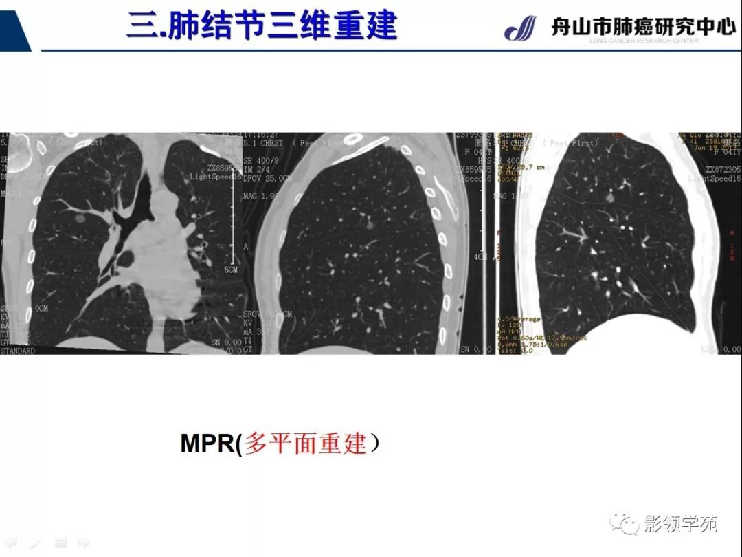 影像PPT - 【PPT】肺磨玻璃结节CT精确检查技术的临床应用-31
