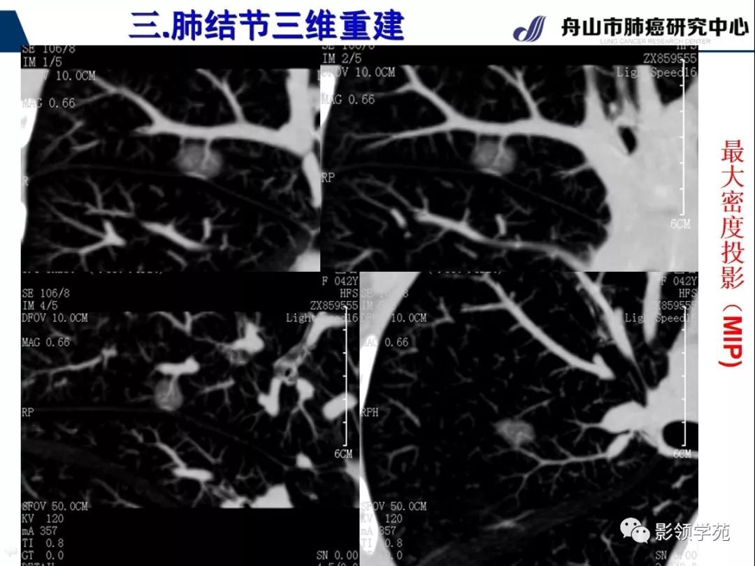 影像PPT - 【PPT】肺磨玻璃结节CT精确检查技术的临床应用-32