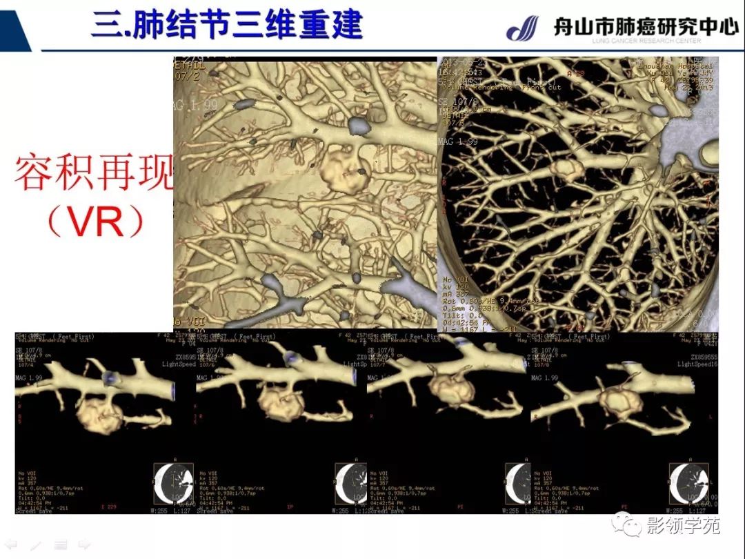 影像PPT - 【PPT】肺磨玻璃结节CT精确检查技术的临床应用-33