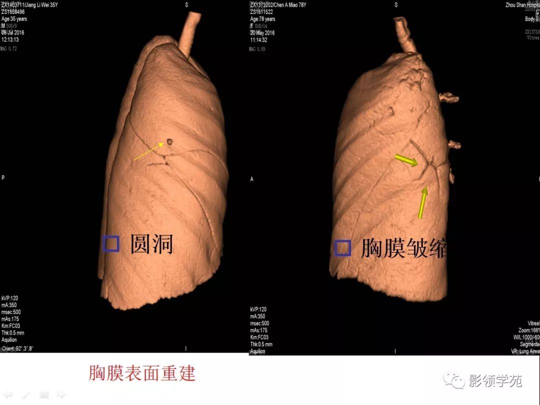 影像PPT - 【PPT】肺磨玻璃结节CT精确检查技术的临床应用-34