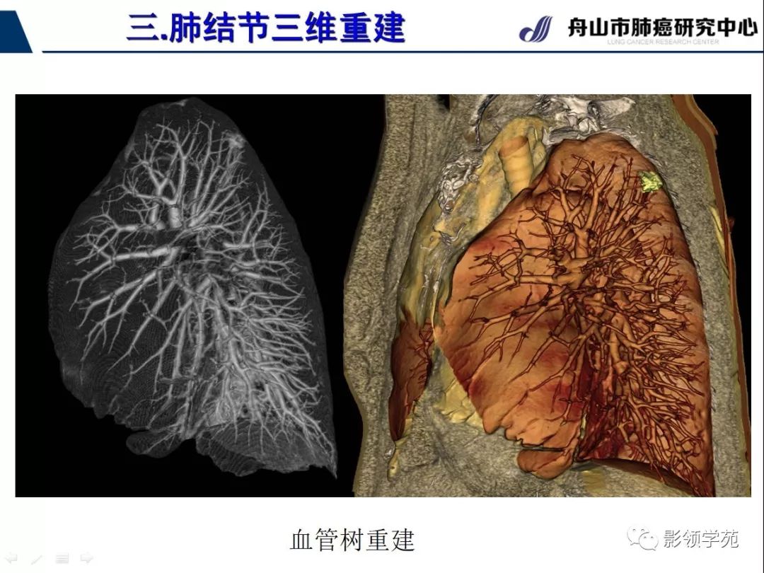 影像PPT - 【PPT】肺磨玻璃结节CT精确检查技术的临床应用-35