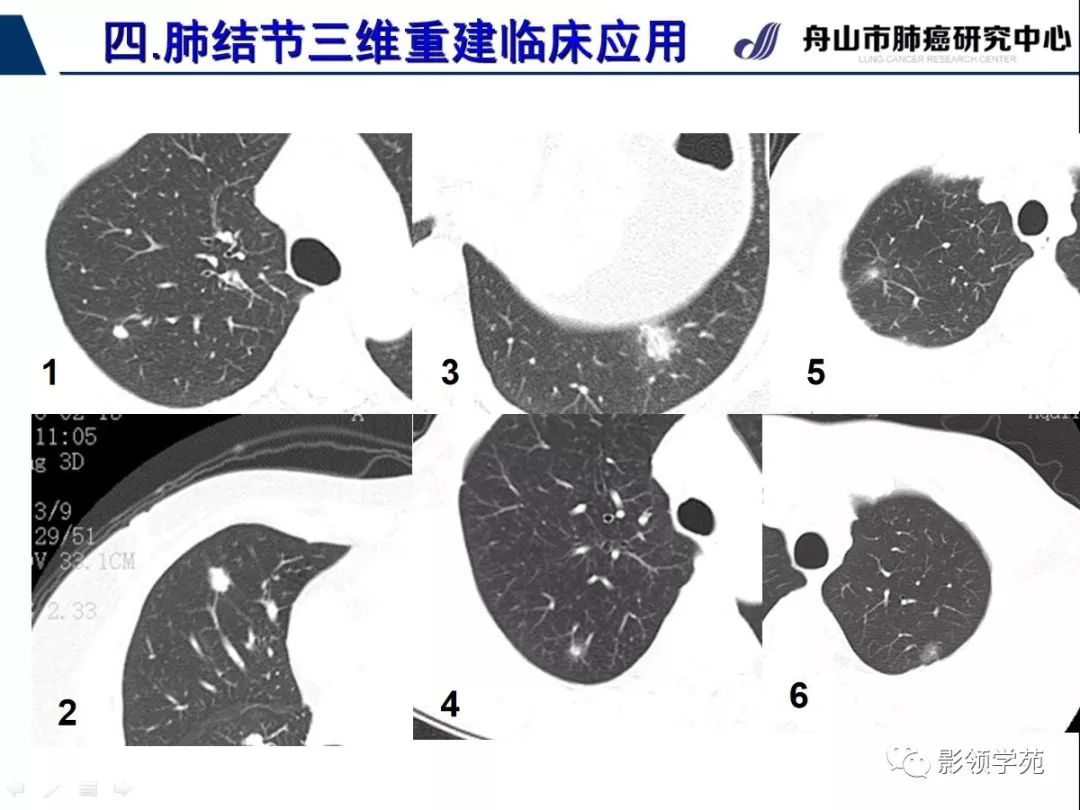 影像PPT - 【PPT】肺磨玻璃结节CT精确检查技术的临床应用-37