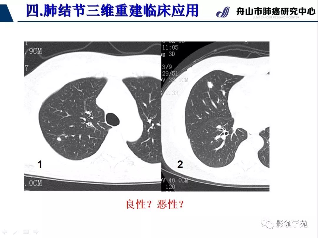 影像PPT - 【PPT】肺磨玻璃结节CT精确检查技术的临床应用-38