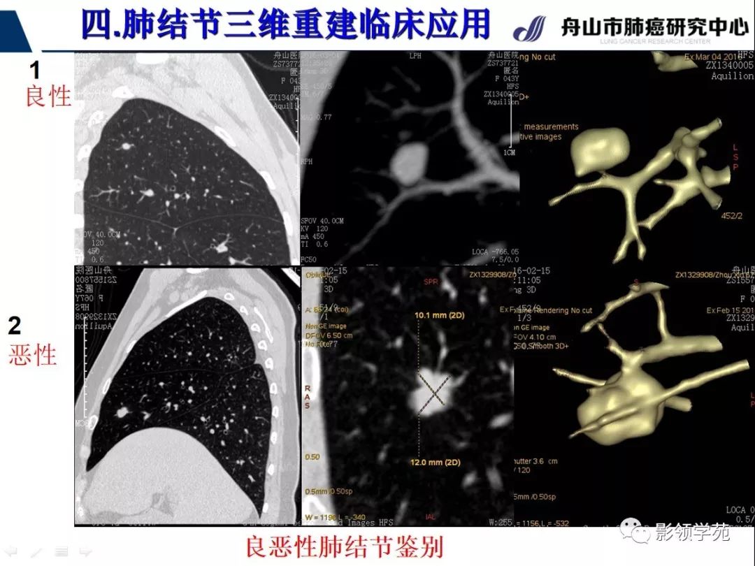 影像PPT - 【PPT】肺磨玻璃结节CT精确检查技术的临床应用-39