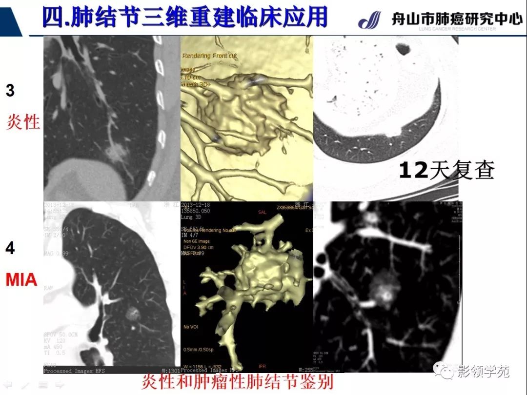 影像PPT - 【PPT】肺磨玻璃结节CT精确检查技术的临床应用-40