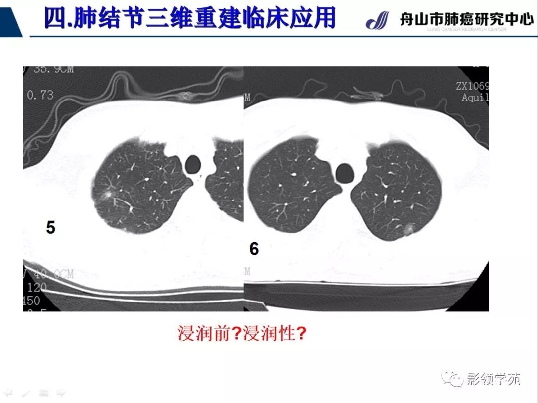 影像PPT - 【PPT】肺磨玻璃结节CT精确检查技术的临床应用-41