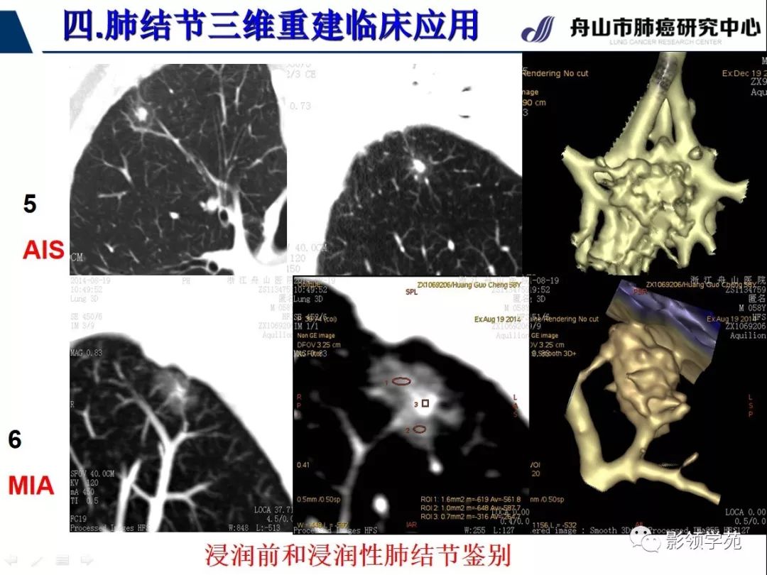影像PPT - 【PPT】肺磨玻璃结节CT精确检查技术的临床应用-42