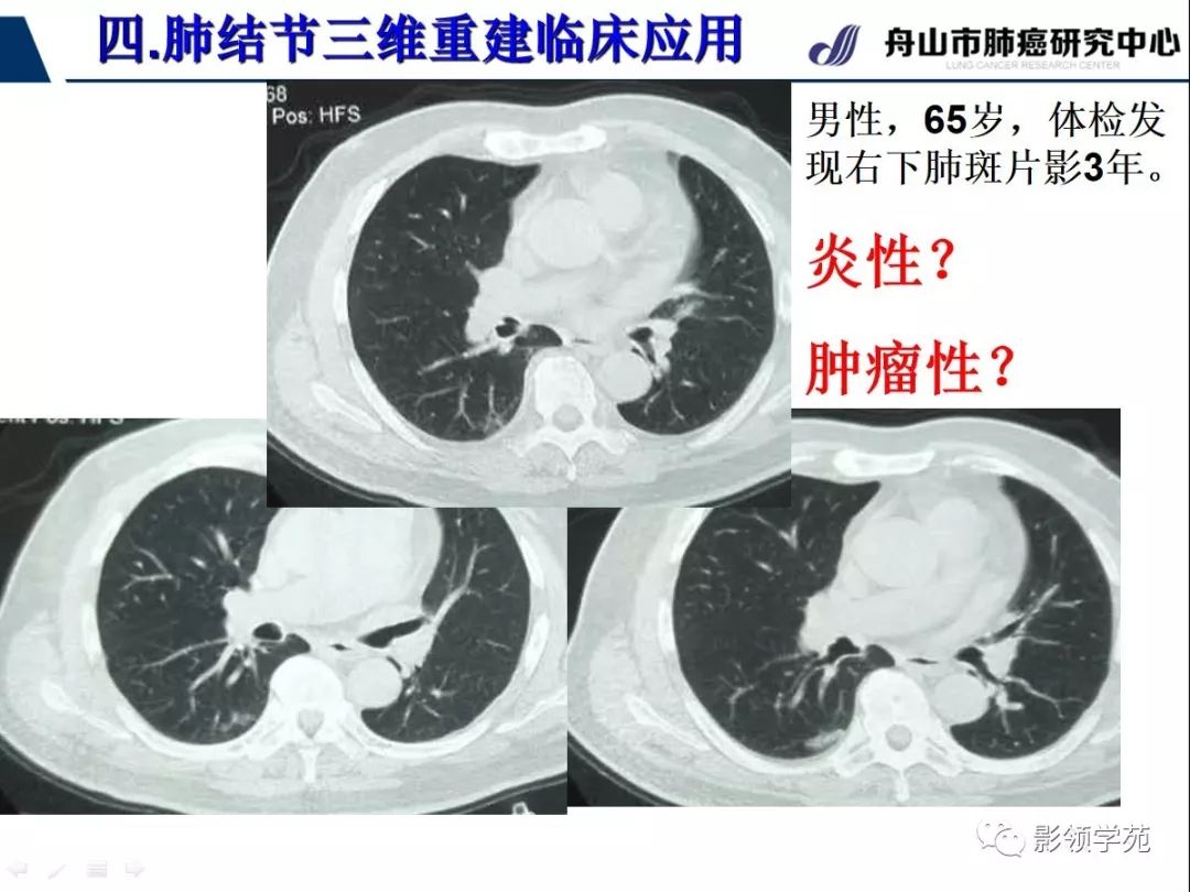 影像PPT - 【PPT】肺磨玻璃结节CT精确检查技术的临床应用-43
