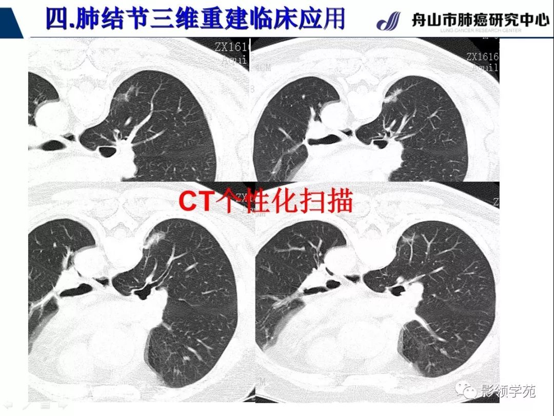 影像PPT - 【PPT】肺磨玻璃结节CT精确检查技术的临床应用-44
