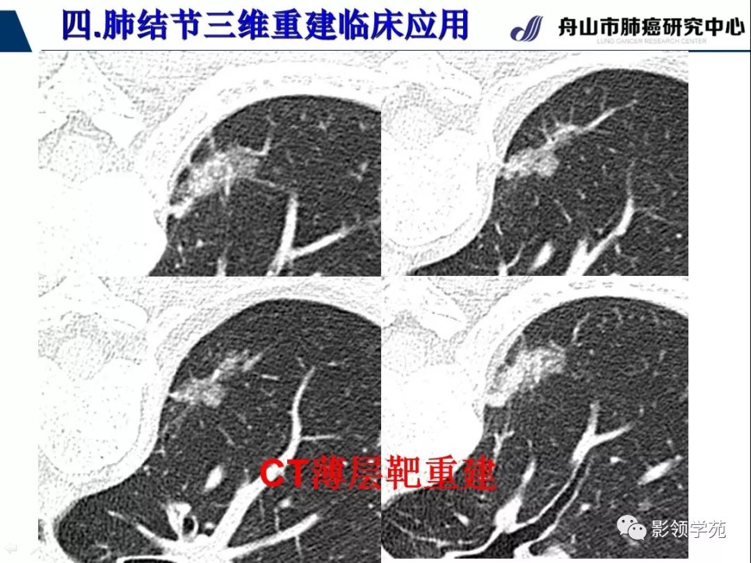 影像PPT - 【PPT】肺磨玻璃结节CT精确检查技术的临床应用-45