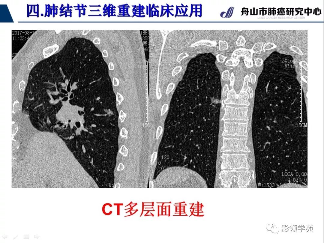 影像PPT - 【PPT】肺磨玻璃结节CT精确检查技术的临床应用-46