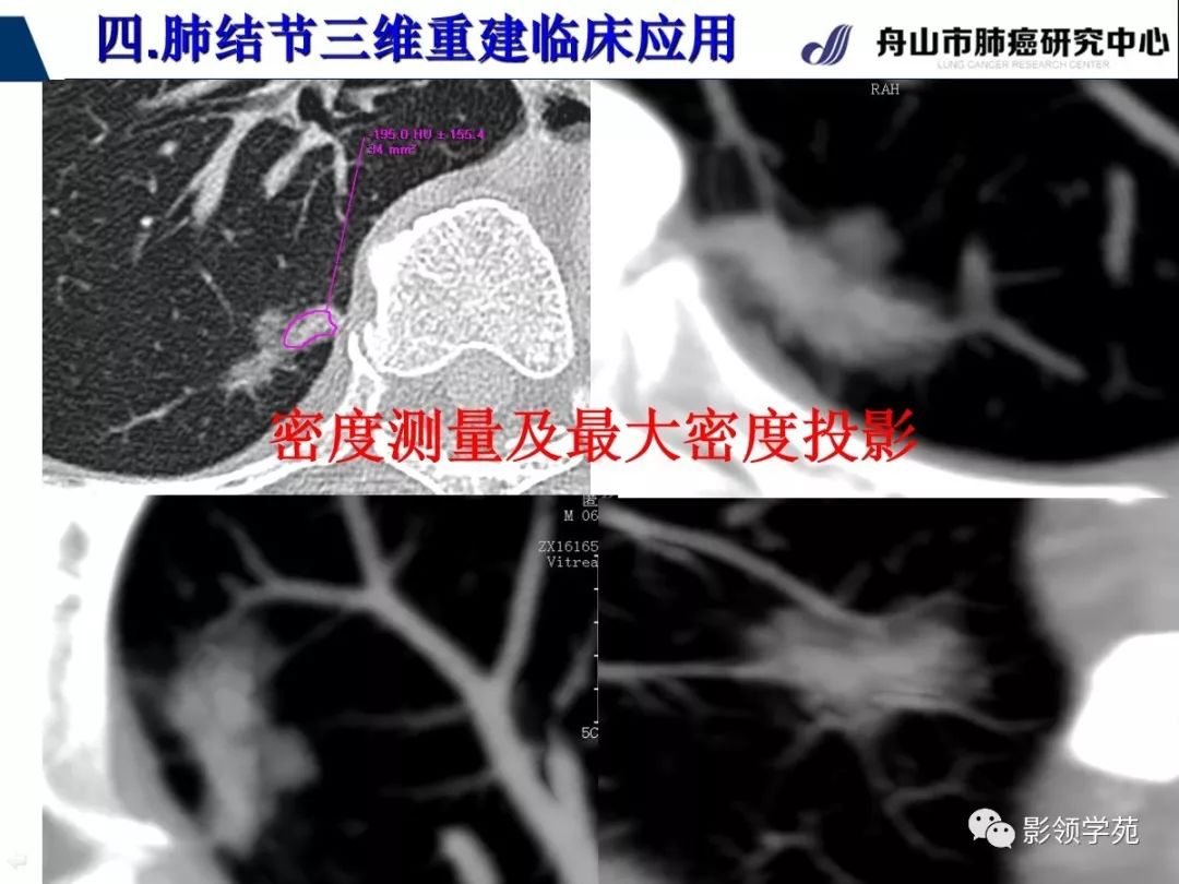 影像PPT - 【PPT】肺磨玻璃结节CT精确检查技术的临床应用-47