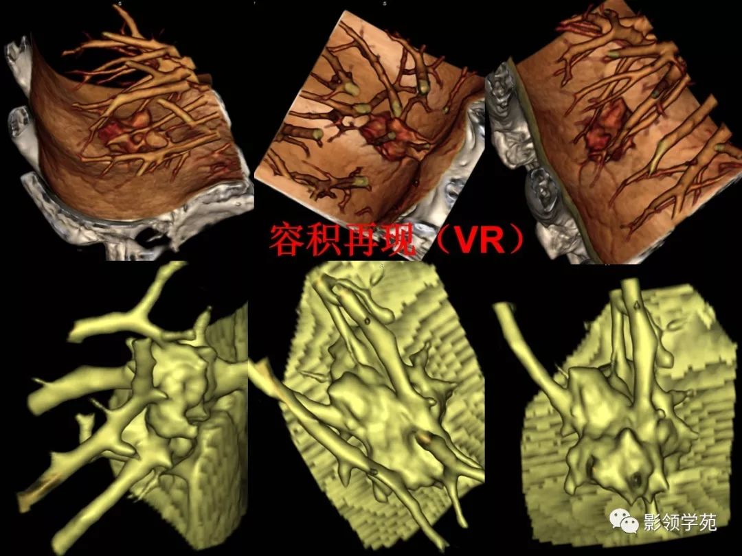 影像PPT - 【PPT】肺磨玻璃结节CT精确检查技术的临床应用-48