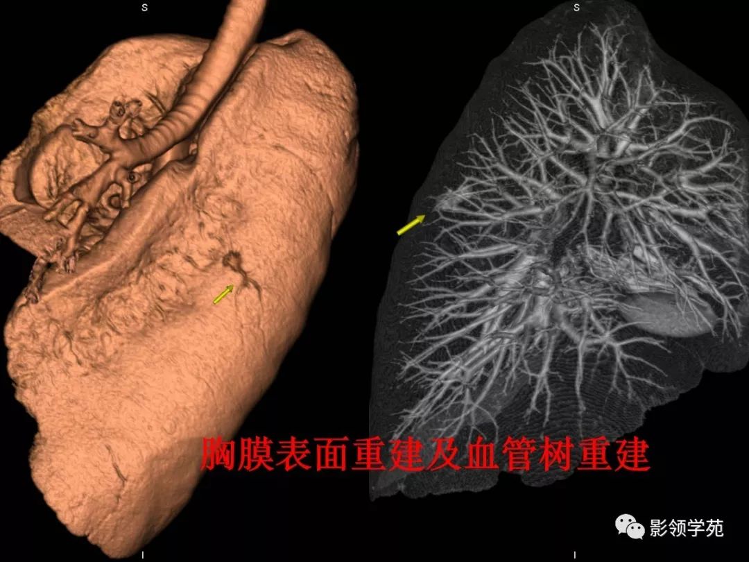 影像PPT - 【PPT】肺磨玻璃结节CT精确检查技术的临床应用-49