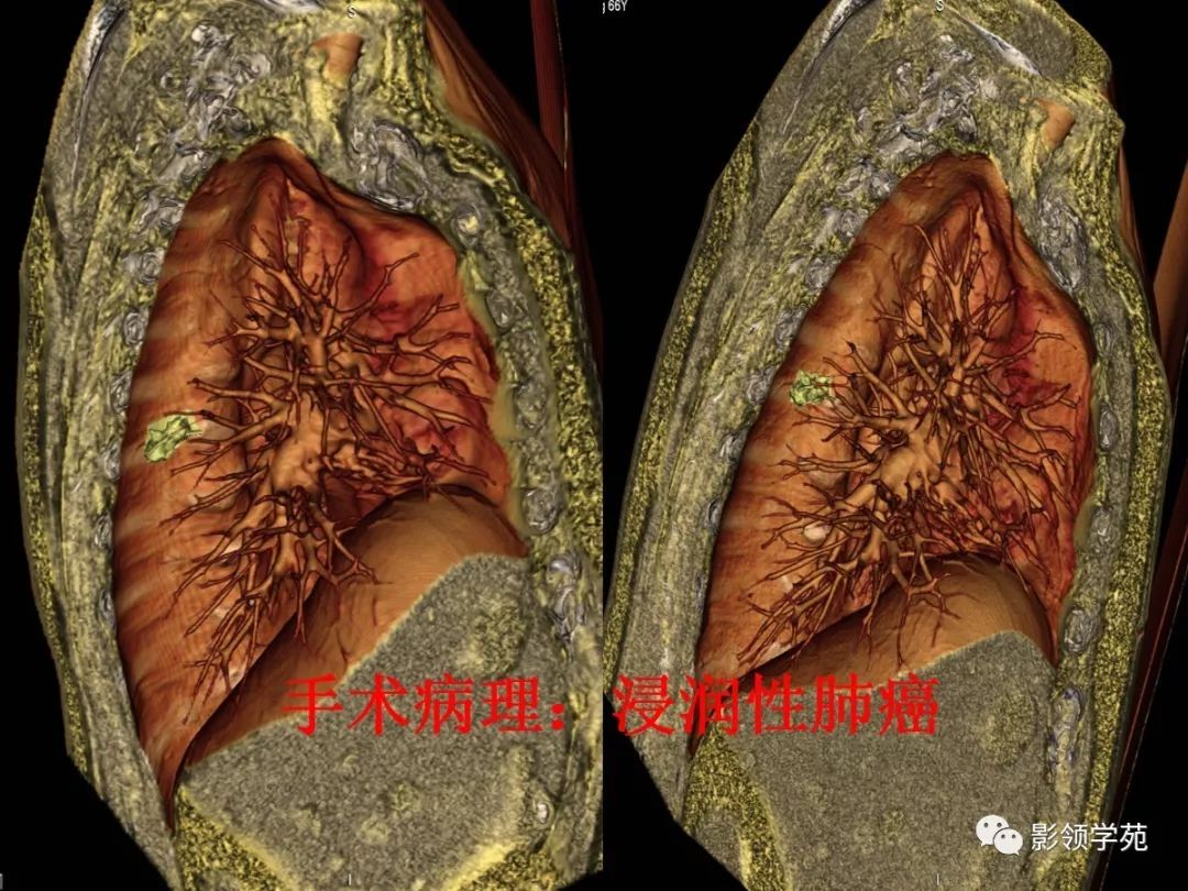影像PPT - 【PPT】肺磨玻璃结节CT精确检查技术的临床应用-50