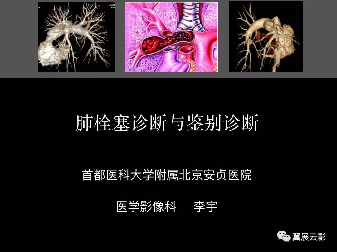 影像PPT - 【PPT】肺栓塞影像诊断与鉴别-1
