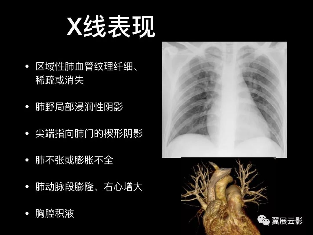 影像PPT - 【PPT】肺栓塞影像诊断与鉴别-5