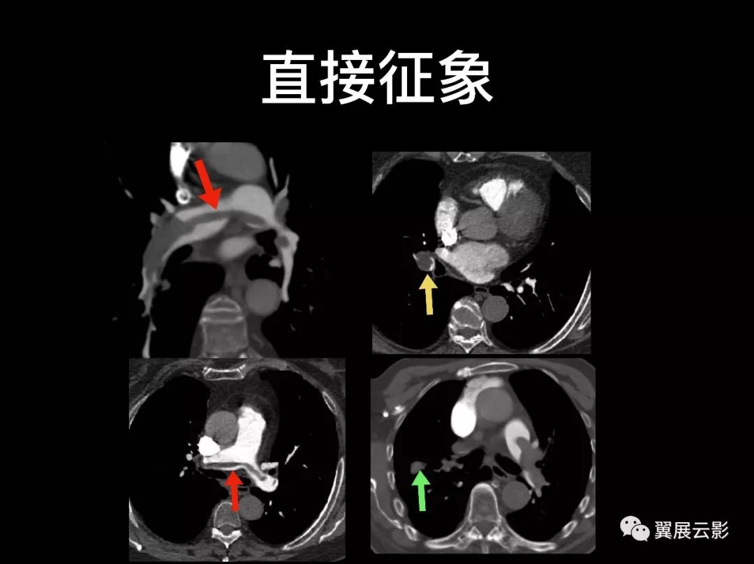 影像PPT - 【PPT】肺栓塞影像诊断与鉴别-7