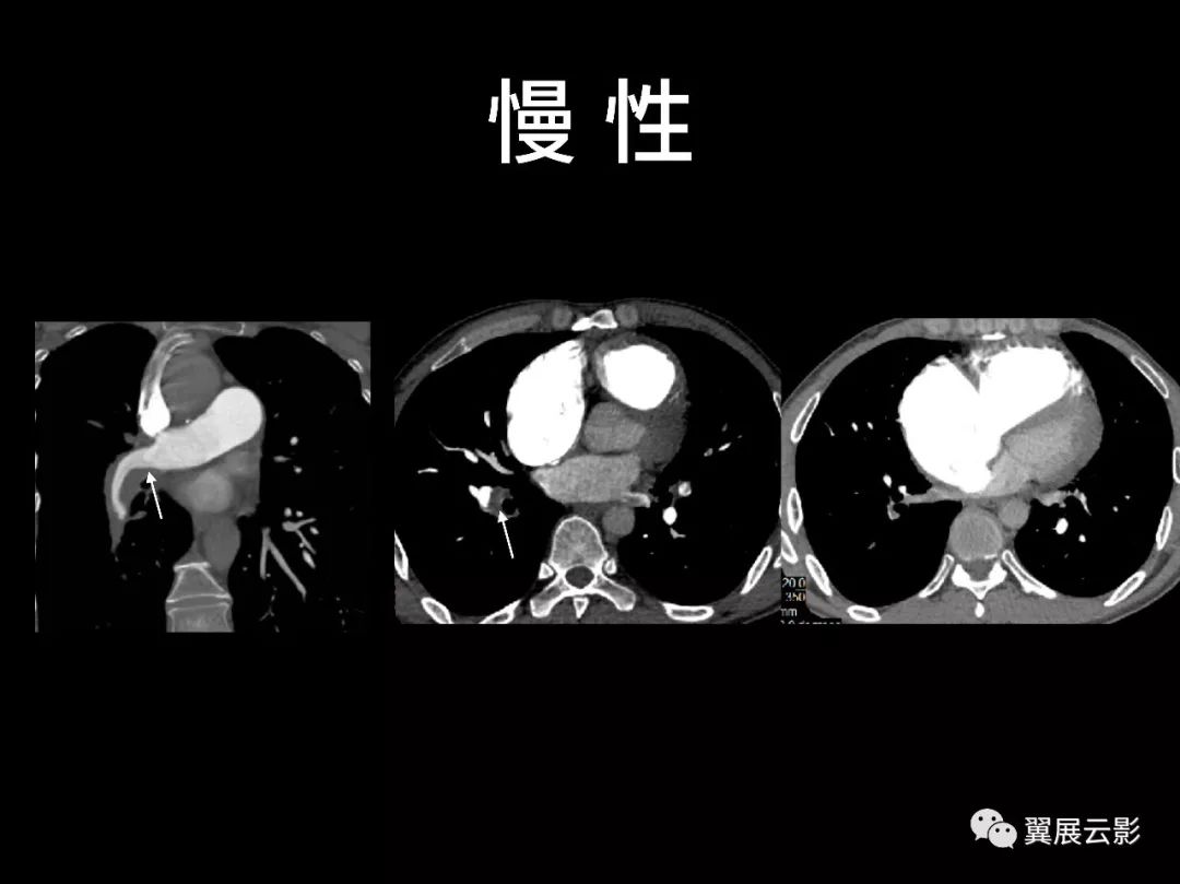 影像PPT - 【PPT】肺栓塞影像诊断与鉴别-8