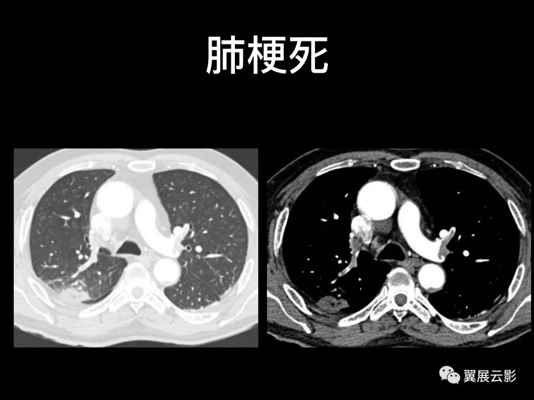 影像PPT - 【PPT】肺栓塞影像诊断与鉴别-10
