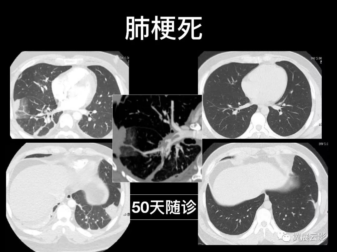 影像PPT - 【PPT】肺栓塞影像诊断与鉴别-11