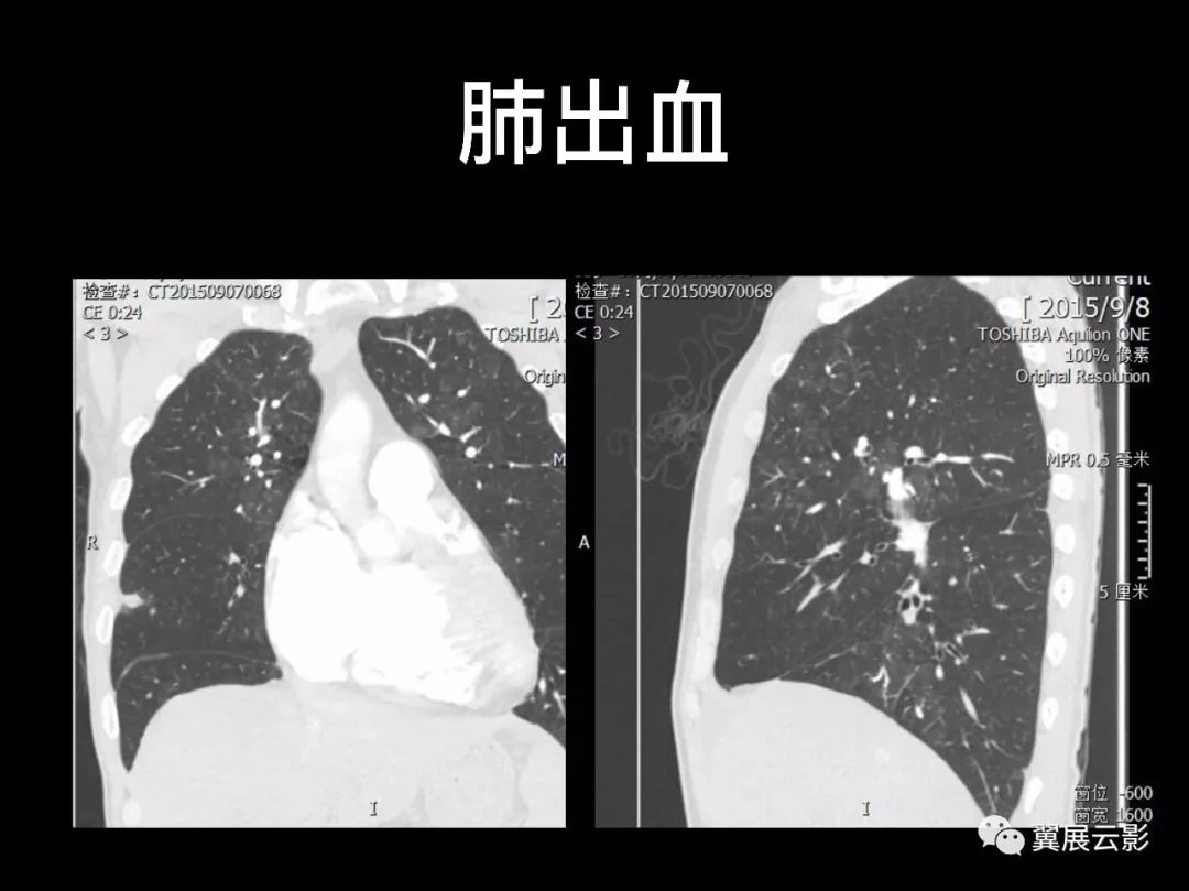 影像PPT - 【PPT】肺栓塞影像诊断与鉴别-12