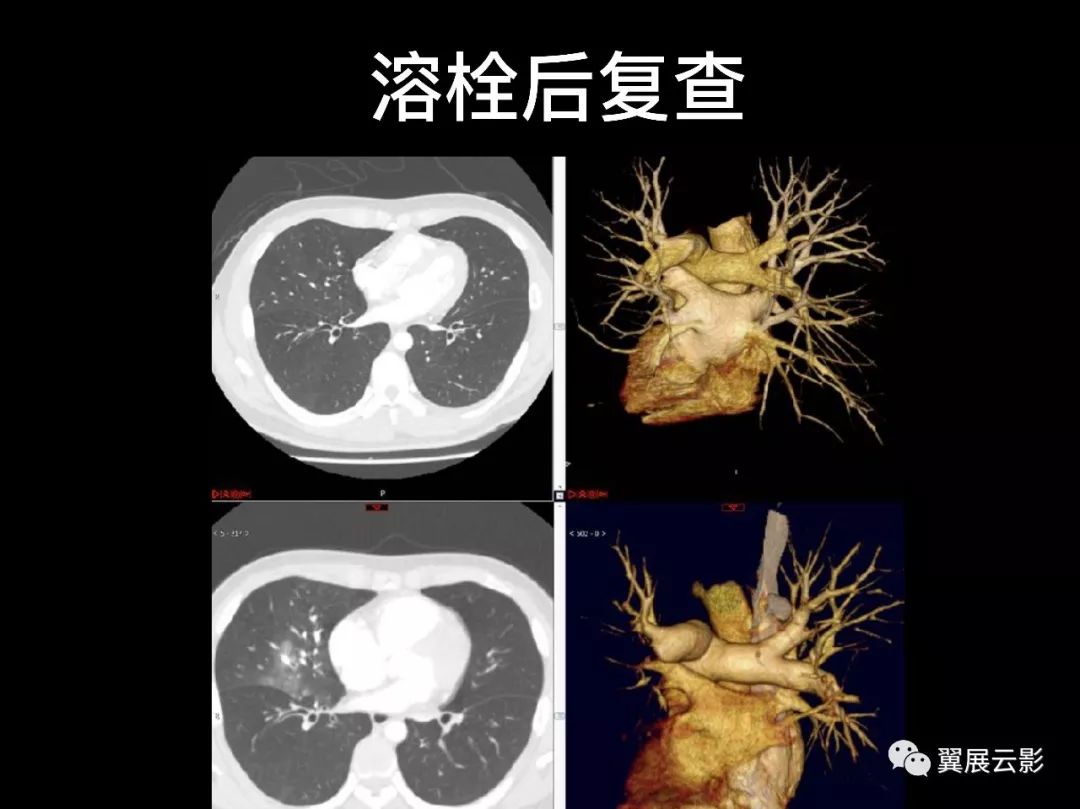 影像PPT - 【PPT】肺栓塞影像诊断与鉴别-13