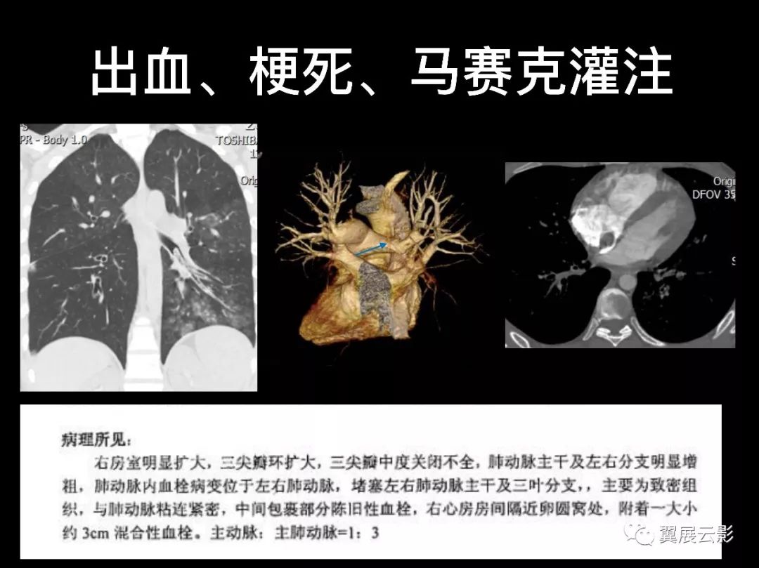 影像PPT - 【PPT】肺栓塞影像诊断与鉴别-14
