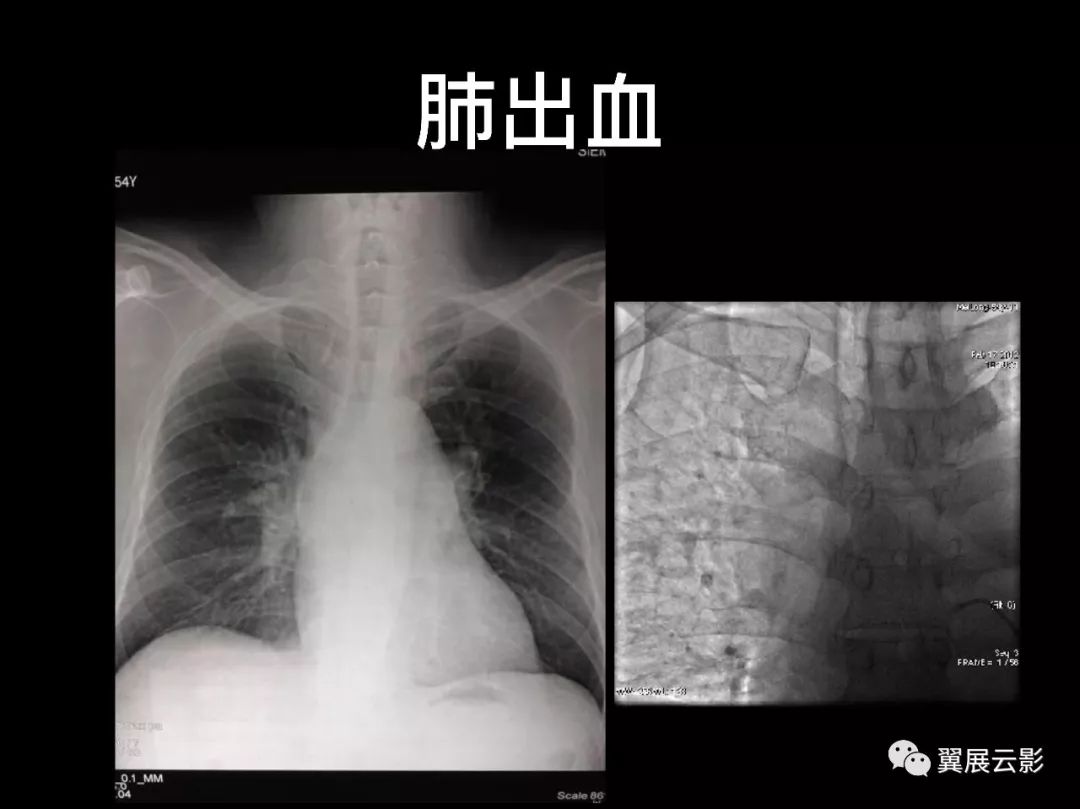 影像PPT - 【PPT】肺栓塞影像诊断与鉴别-15