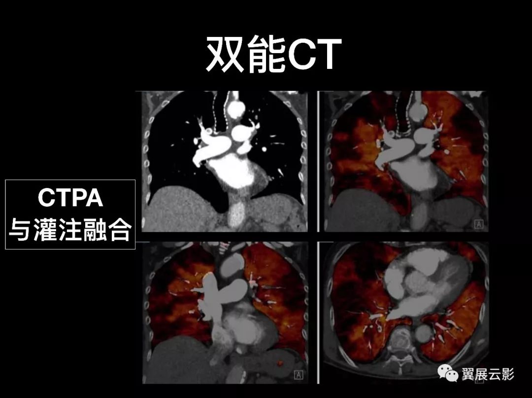 影像PPT - 【PPT】肺栓塞影像诊断与鉴别-17